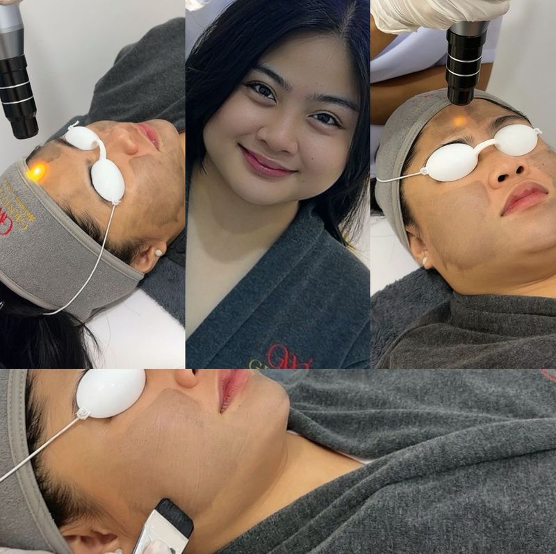 Carbon Laser Hollywood Peel Carbon Laser Peel